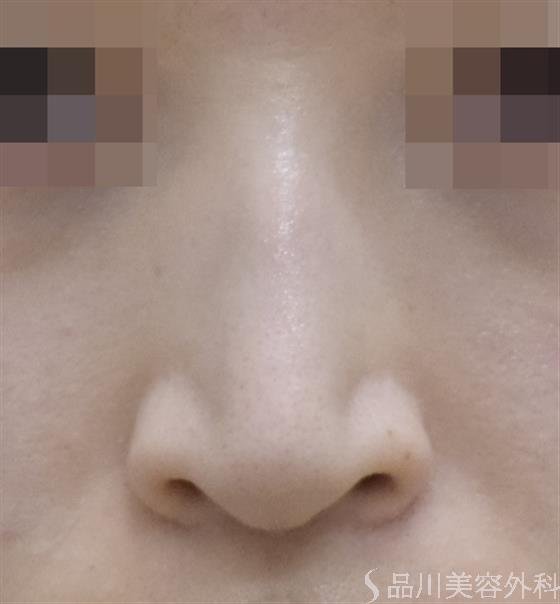 症例NO.50388のBEFORE写真
