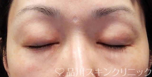 症例NO.68898のBEFORE写真