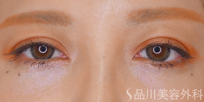 症例NO.69650のAFTER写真