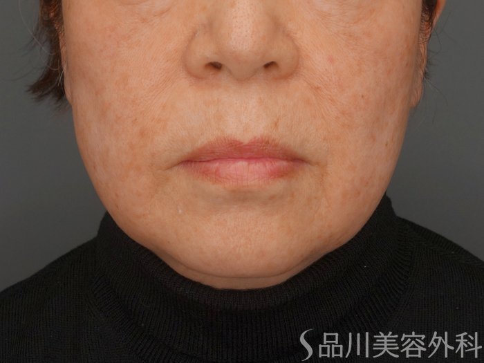 症例NO.64250のBEFORE写真
