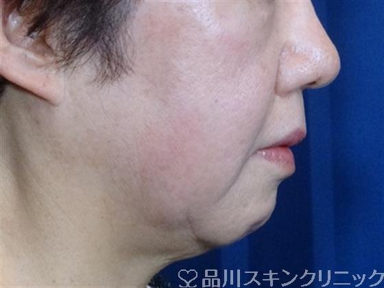 症例NO.32766のBEFORE写真