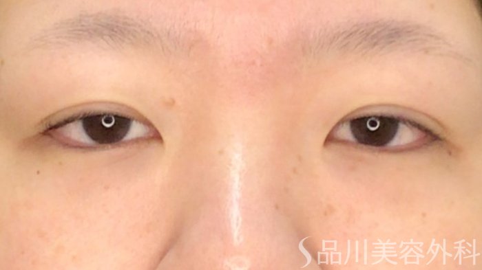 症例NO.71781のAFTER写真
