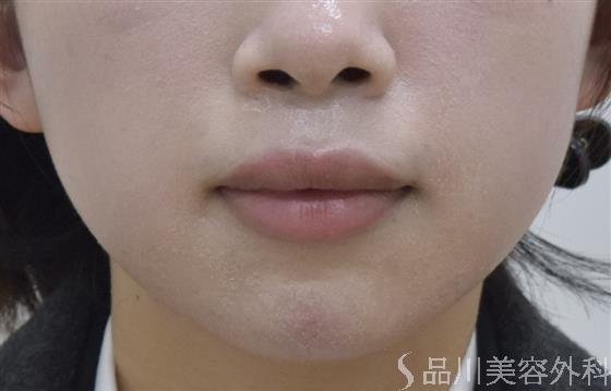 症例NO.46844のAFTER写真