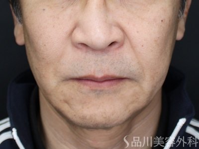 症例NO.73471のAFTER写真