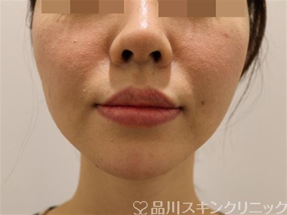 症例NO.43255のAFTER写真
