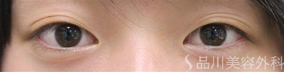 症例NO.21646のBEFORE写真