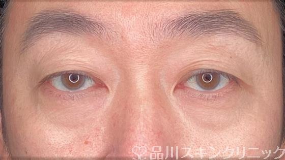 症例NO.61848のBEFORE写真