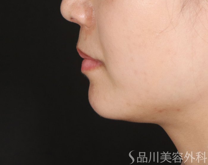 症例NO.73751のBEFORE写真