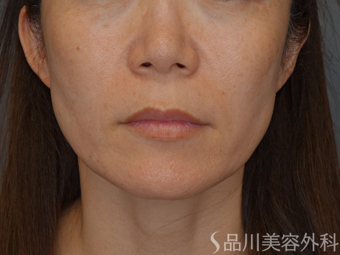 症例NO.75088のBEFORE写真