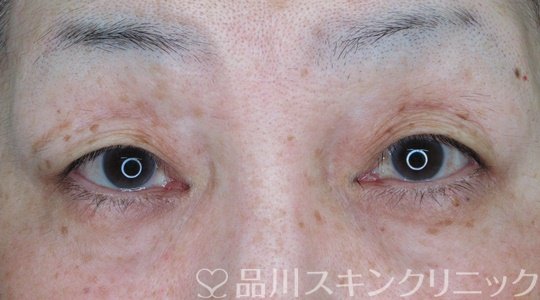 症例NO.70634のBEFORE写真