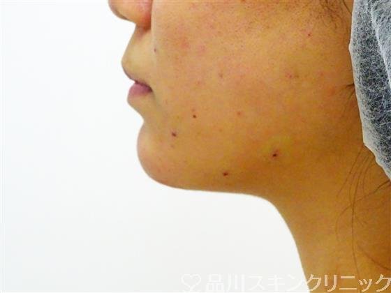 症例NO.44910のAFTER写真