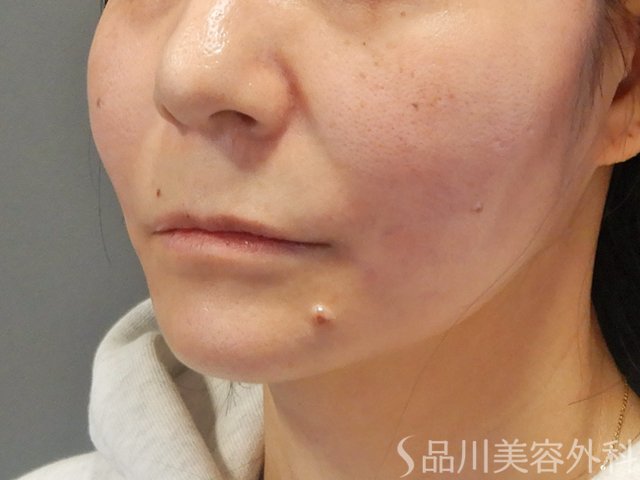 症例NO.73685のAFTER写真