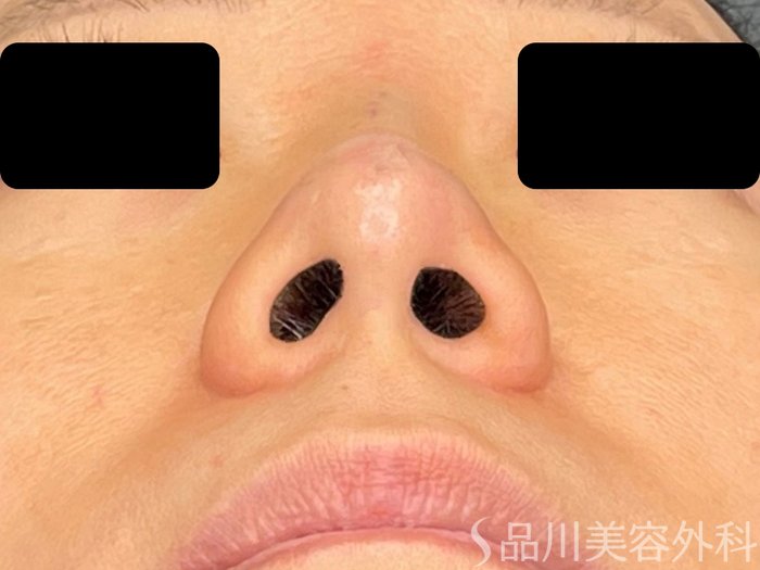 症例NO.72343のAFTER写真