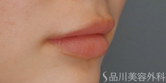 症例NO.69243のAFTER写真