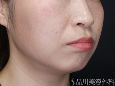 症例NO.71696のAFTER写真