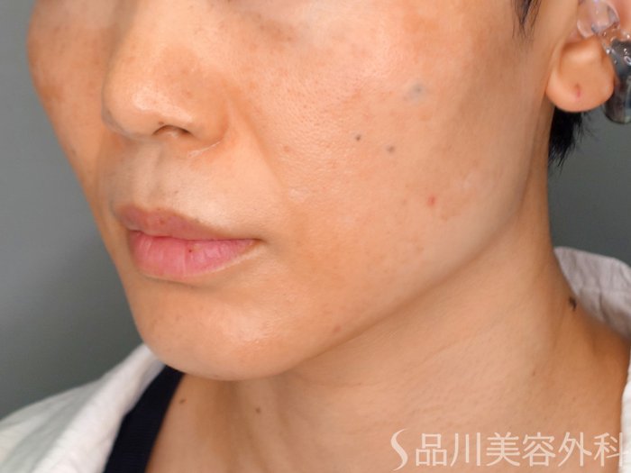 症例NO.69173のAFTER写真
