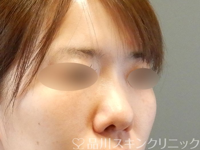 症例NO.62842のBEFORE写真