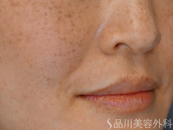 症例NO.68201のBEFORE写真