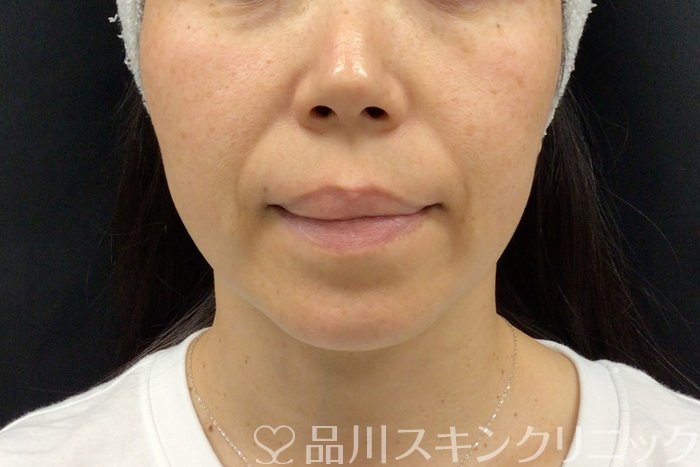 症例NO.71279のBEFORE写真