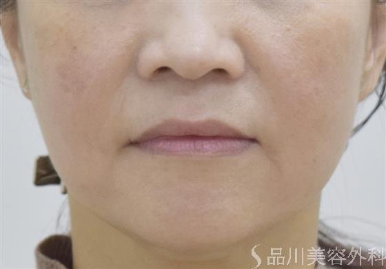 症例NO.47548のAFTER写真