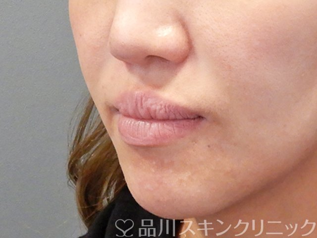 症例NO.71241のBEFORE写真