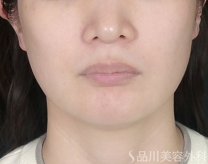 症例NO.65698のBEFORE写真
