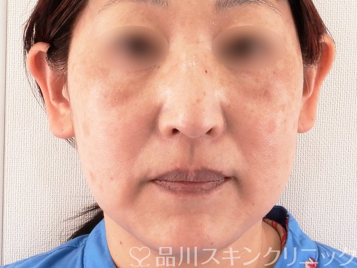 症例NO.62471のAFTER写真