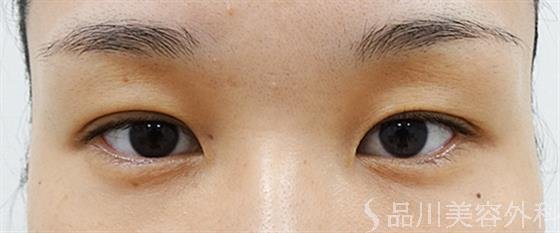 症例NO.53383のBEFORE写真