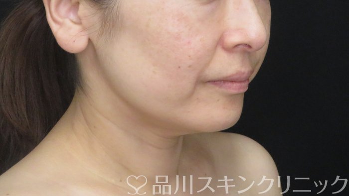 症例NO.71575のBEFORE写真