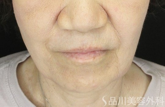 症例NO.65306のBEFORE写真