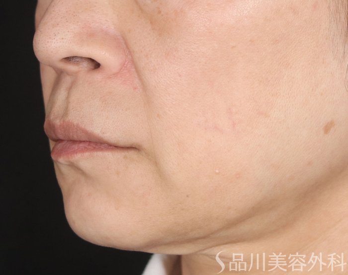 症例NO.72878のBEFORE写真