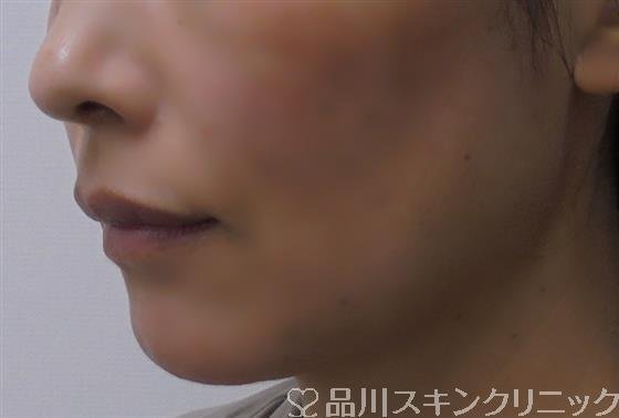 症例NO.40317のAFTER写真