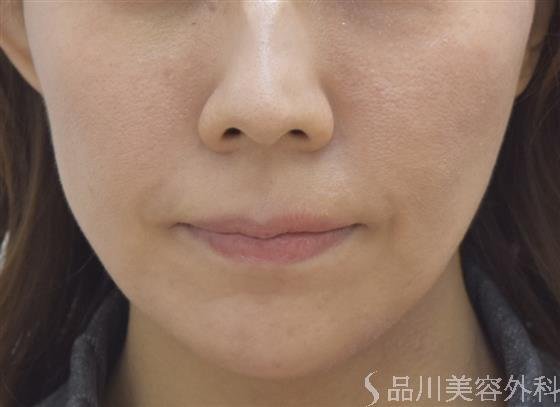 症例NO.45066のAFTER写真