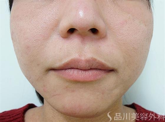 症例NO.16776のBEFORE写真