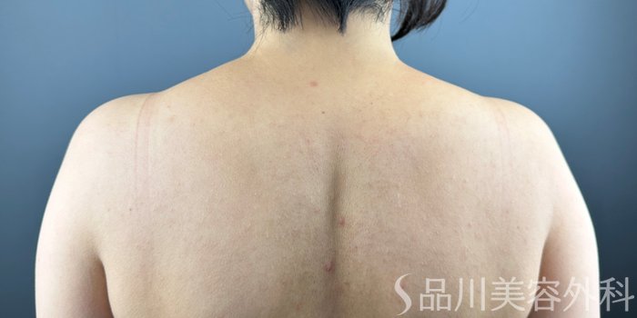 症例NO.70356のBEFORE写真