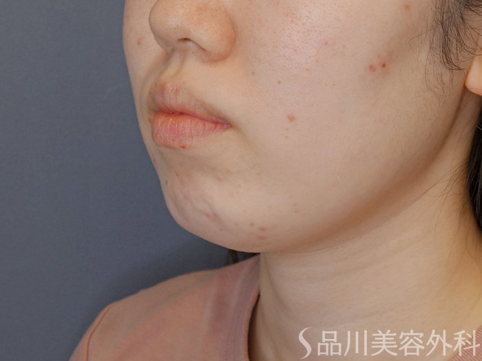 症例NO.71362のBEFORE写真