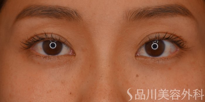 症例NO.73722のAFTER写真