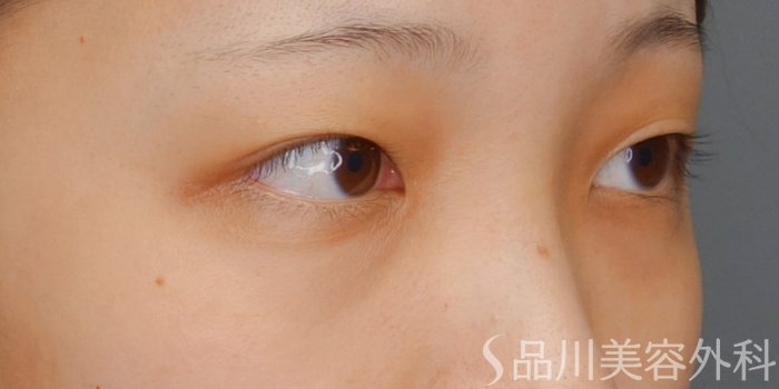 症例NO.73151のBEFORE写真