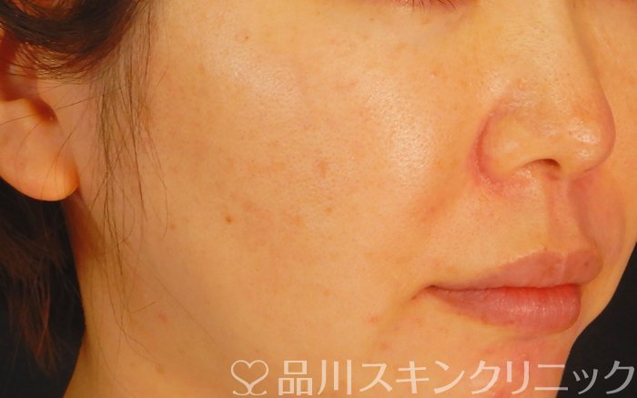 症例NO.66481のAFTER写真