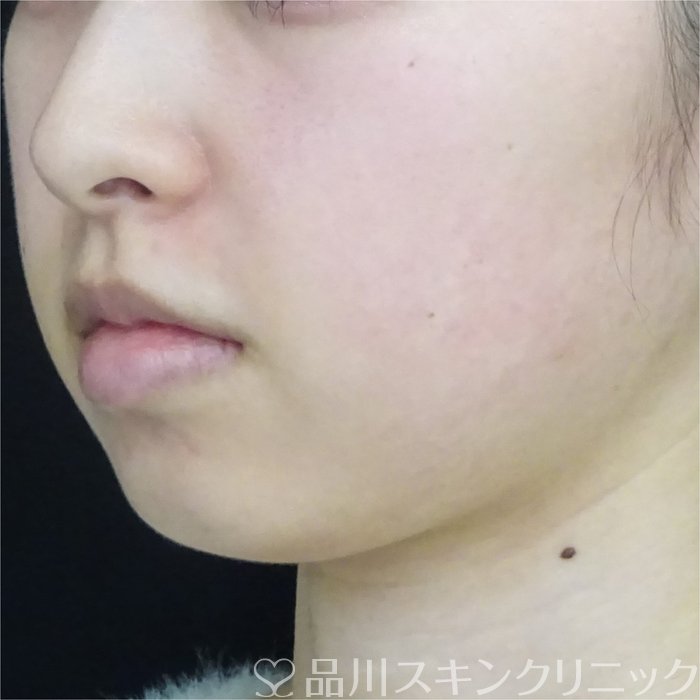症例NO.69411のBEFORE写真