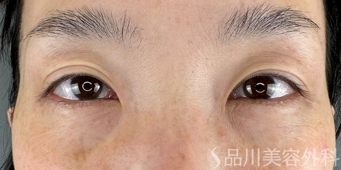 症例NO.65590のBEFORE写真