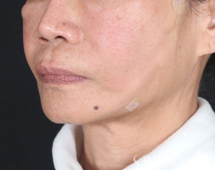 症例NO.72776のAFTER写真