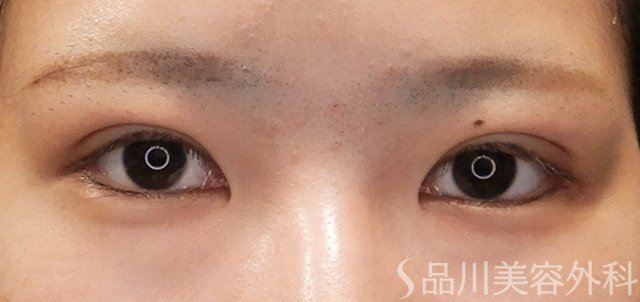 症例NO.72382のAFTER写真