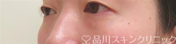 症例NO.54518のBEFORE写真