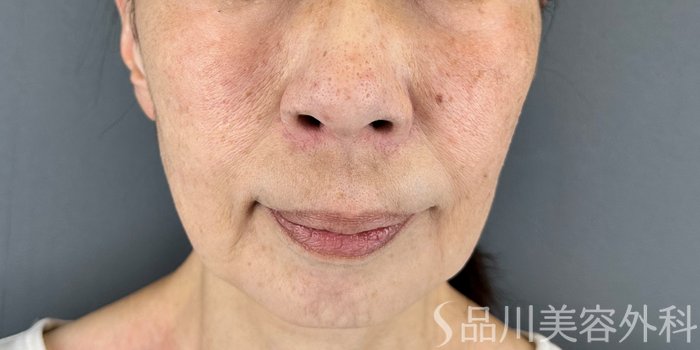 症例NO.69170のBEFORE写真