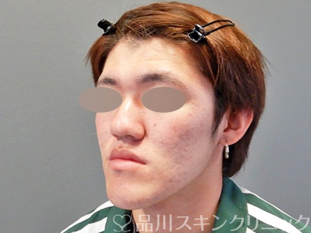 症例NO.69061のAFTER写真