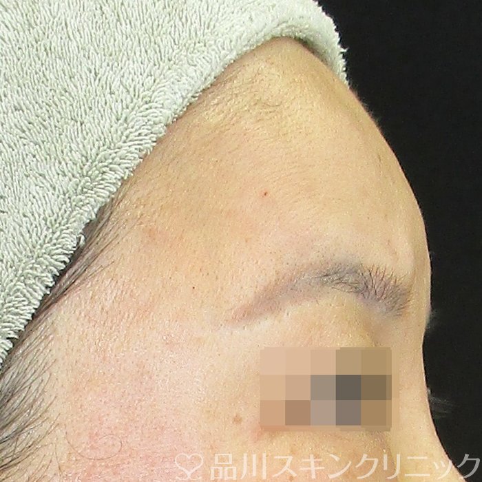 症例NO.74094のAFTER写真