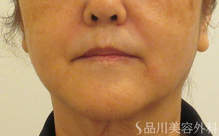 症例NO.73535のAFTER写真