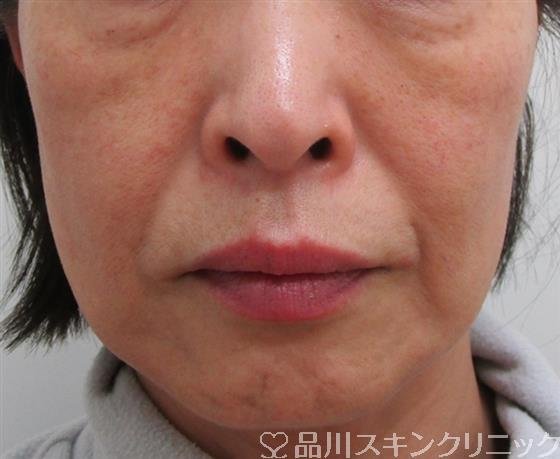 症例NO.33713のBEFORE写真