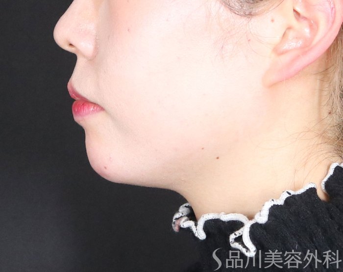 症例NO.72996のAFTER写真